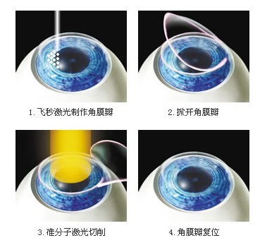 飞秒激光 飞秒激光