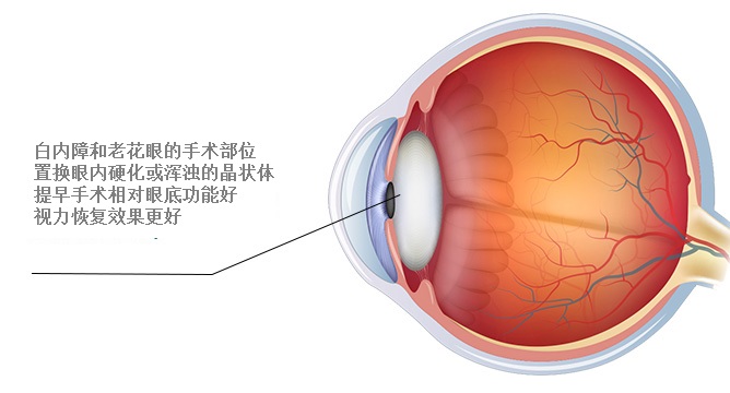 老花手术与白内障手术的关联 老花手术与白内障手术的关联