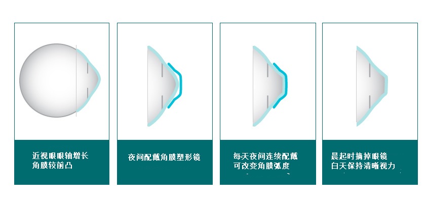 青少年近视控制(OK镜) 青少年近视控制(OK镜)