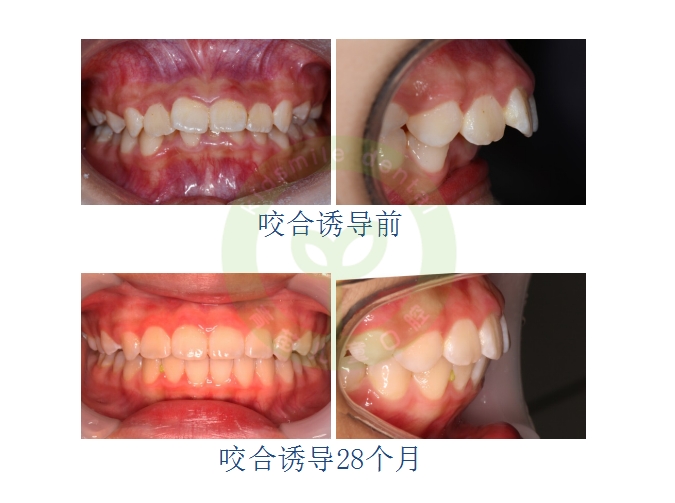 遗传因素 其前牙深覆盖多伴有明显的骨骼畸形,例如上颌过度发育或下颌