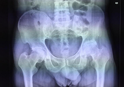 Clinical Experiment: Comparison X-ray image before and after taken Collagen Type II four months