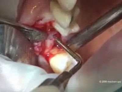 Ultrasound osteotome for maxillary sinus lifting surgery