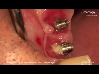 牙科超声治疗仪种植体清洁